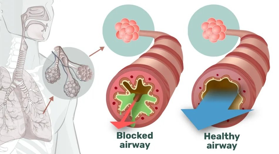Cross-section comparing a mucus-blocked airway and a clear, healthy airway